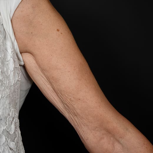 Saggy Arms After Weight Loss