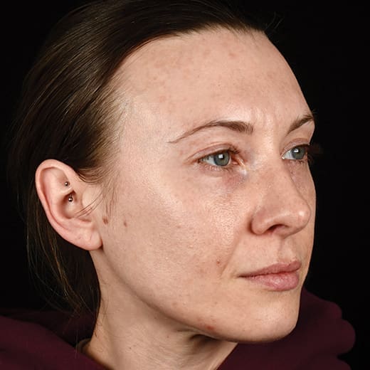 Freckles