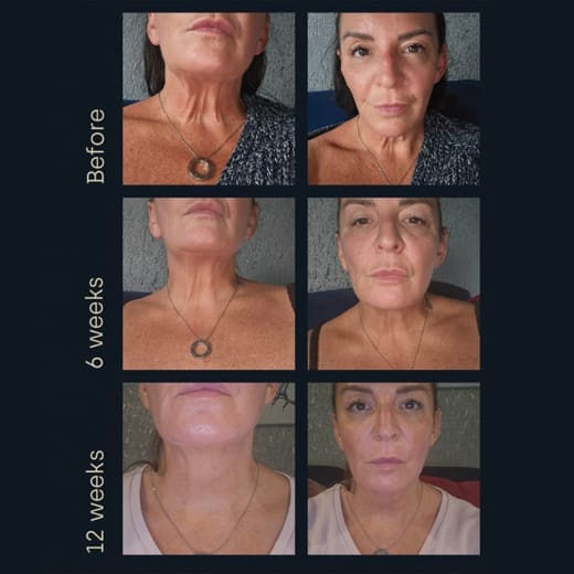 sofwave collagen loss face glp-1 weight loss changed the conversation around loss. But nobody prepared people for the skin side of rapid transformation. When fat volume decreases quickly, the body changes faster than the skin can fully Improving Aesthetic Results for GLP-1